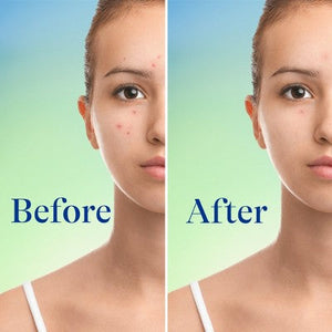 Differin Maximum Strength Foaming Acne Face and Body Wash with 10% Benzoyl Peroxide 5 fl oz - Imperfect Box