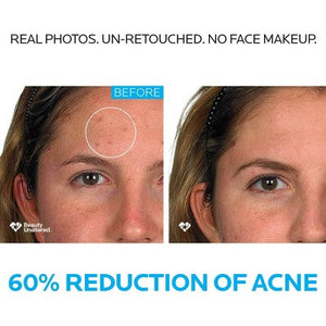 La Roche Posay Effaclar Dermatological Acne Treatment 3-Step System Kit Medicated Gel Cleanser 7.5 fl oz - Imperfect Box