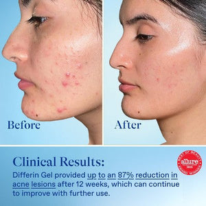 Differin Acne Retinoid Face and Body Treatment Gel Adapalene 0.1% 45g - Imperfect Box