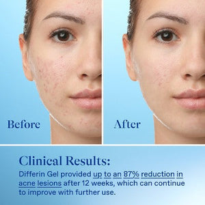 Differin Acne Retinoid Face and Body Treatment Gel Adapalene 0.1% 45g - Imperfect Box