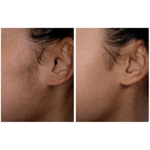 Spa Sciences SIMA Deluxe Sonic Dermaplaning Tool for Exfoliation & Peach Fuzz Removal - Imperfect Box