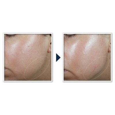 RoC Derm Correxion Contour Cream for Face and Neck 1.7oz